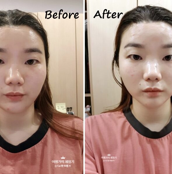 날렵한 턱선을 만들어준 까치산점 약손명가 언니들께 무한한 감사를 :)