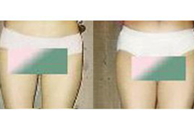 [Hip-up(Pelvic)Care] Mangwon Before / after 10 sessions