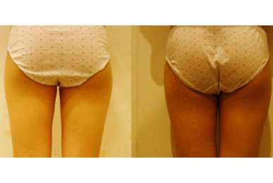 [Hip-up(Pelvic)Care] Daejeon Before / after 20 sessions