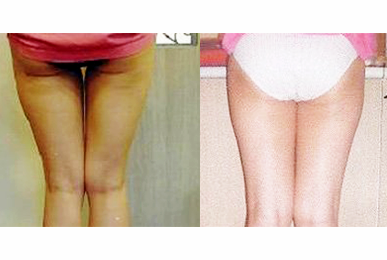 [Hip-up(Pelvic)Care] Sadang Before / after 10 sessions