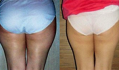 [Hip-up(Pelvic)Care] Busan Seomyeon D Before / after 10 sessions