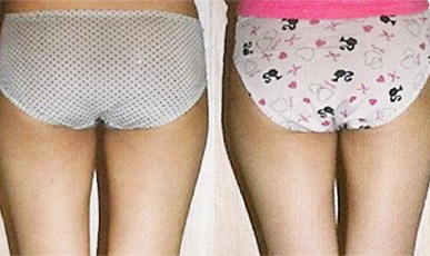 [Leg straightening care] Busan Haeundae B Before / after 10 sessions