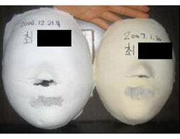 Seoul Suyu Before / after 20 sessions