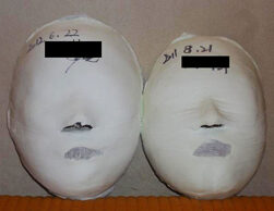 Seolleung Before / After 10 Sessions
