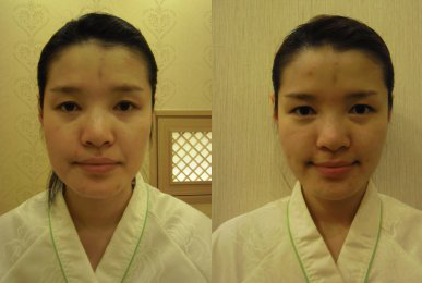 Choi Gil-hyeon after 16 sessions (Intensive Jaw)