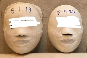 [Balanced Face]Busan Hwamyeong Before&After/ 20sessions