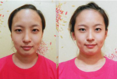 Song Jeong-ui (Forehead)