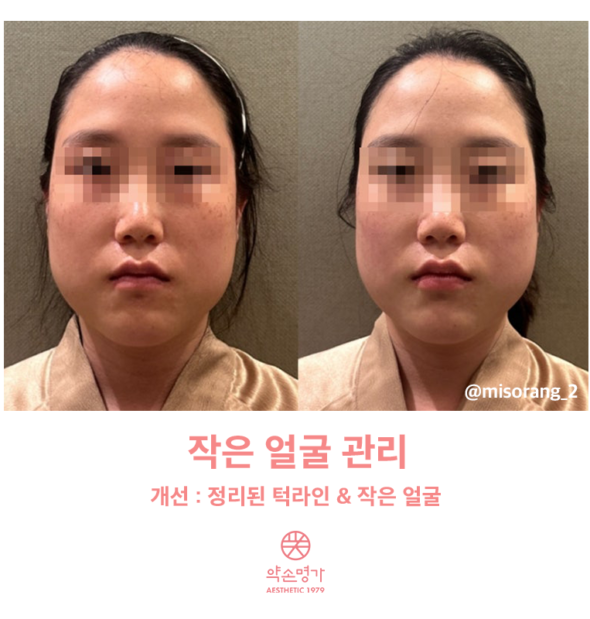 [약손명가 솔직 후기] 부산해운대점에서 작은 얼굴 관리받아 본 후기 + 비포애프터