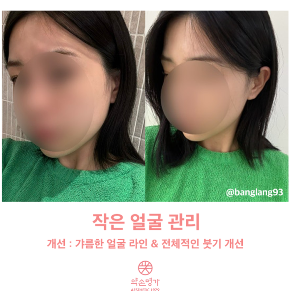 약손명가 청담점에서 웨딩관리로 작은 얼굴 관리받아본 후기