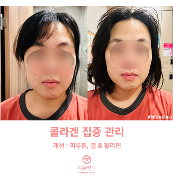 솔직후기 약손명가동탄1동점에서 동탄 피부관리 받아봄!